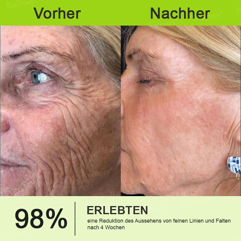 👨‍⚕️Jetzt jugendliche Haut zurückgewinnen 💫Rolimey® Botox & Vita-A Retinol Shot Falten-Lift Straffungscreme