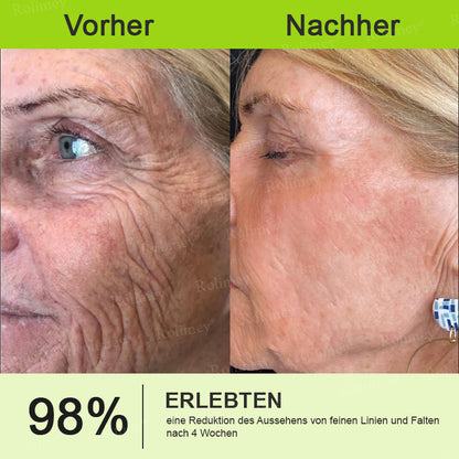 👨‍⚕️Jetzt jugendliche Haut zurückgewinnen 💫Rolimey® Botox & Vita-A Retinol Shot Falten-Lift Straffungscreme