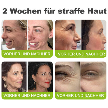 👨‍⚕️Jetzt jugendliche Haut zurückgewinnen 💫Rolimey® Botox & Vita-A Retinol Shot Falten-Lift Straffungscreme