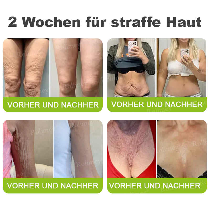 👨‍⚕️Jetzt jugendliche Haut zurückgewinnen 💫Rolimey® Botox & Vita-A Retinol Shot Falten-Lift Straffungscreme