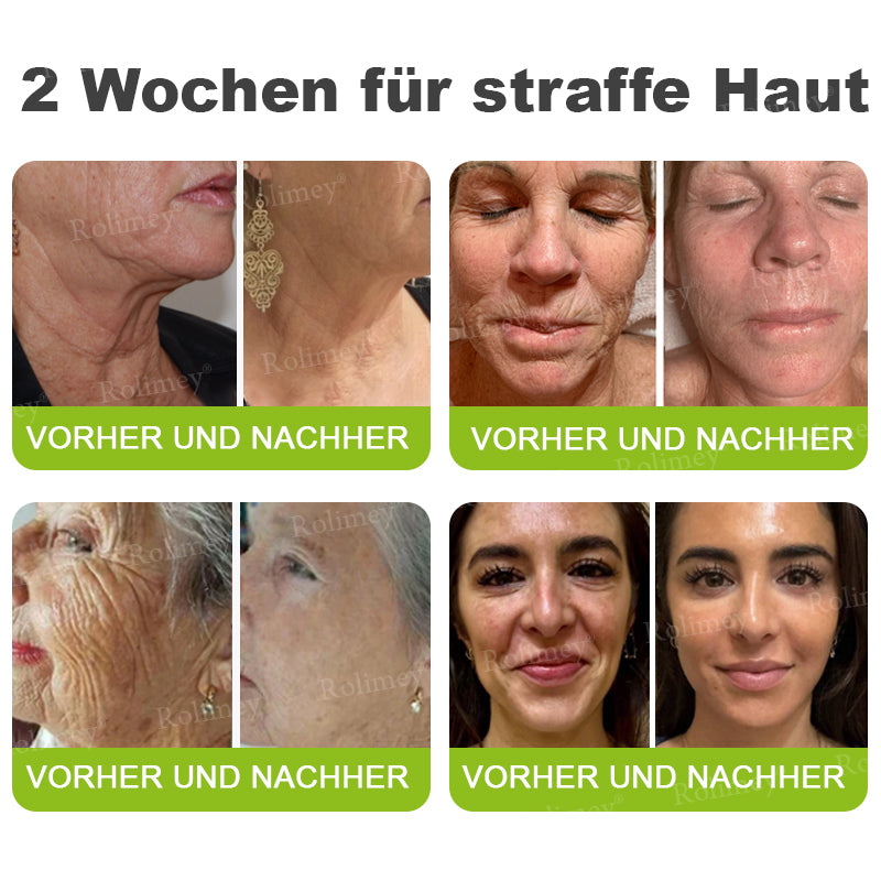 👨‍⚕️Jetzt jugendliche Haut zurückgewinnen 💫Rolimey® Botox & Vita-A Retinol Shot Falten-Lift Straffungscreme