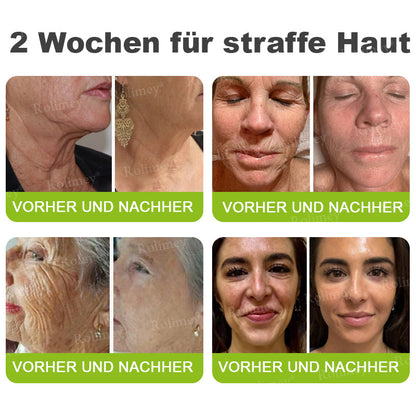 👨‍⚕️Jetzt jugendliche Haut zurückgewinnen 💫Rolimey® Botox & Vita-A Retinol Shot Falten-Lift Straffungscreme